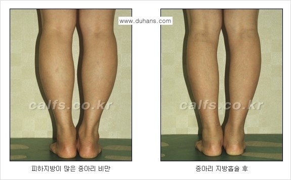 ⁠⁠[두한성형외과 경쟁력 멀티종아리성형] - [지방흡입이 필요한 종아리 비만 안내] 관련 이미지 9