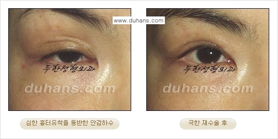 [두한성형외과 경쟁력 눈성형] - [두꺼운 라인을 교정하는 극한 눈 재수술 2.] 관련 이미지 3