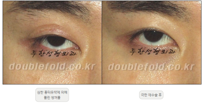 [Double Eyelid Surgery, Duhan Plastic Surgery] - [Extreme Revision Eye Surgery to Correct a Damaged Line] image 30