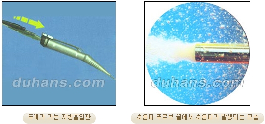 [두한성형외과 안전한 지방흡입] - [얼굴지방흡입] 관련 이미지 4