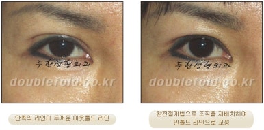 [두한성형외과 쌍커풀재수술] - [심한 소세지눈, 두줄따기, 쌍꺼풀 흉터] 관련 이미지 27