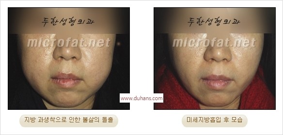 [두한성형외과 경쟁력 미세지방이식] - [지방이식 부작용 교정 모습 안내] 관련 이미지 27