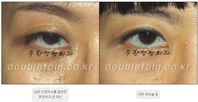 [Double Eyelid Surgery, Duhan Plastic Surgery] - [Extreme Revision Eye Surgery to Correct a Damaged Line] image 24