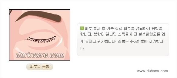 [두한성형외과 경쟁력 다크써클 교정] - [젊어 보이면서 개선된 인상을 주는 하안검 성형술] 관련 이미지 8