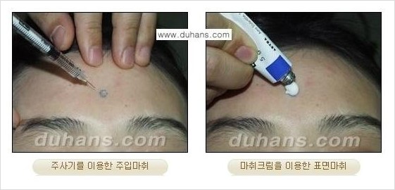 [두한성형외과 안전 제일 성형] - [통증 없는 마취 - 무통 수면마취] 관련 이미지 3