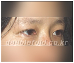 [Dohan Plastic Surgery Double Eyelid Surgery] - [Beautiful Double Eyelids] image 7