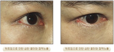 쌍커풀수술 두한성형외과 - 나에게 맞는 눈성형은? 관련 이미지 72