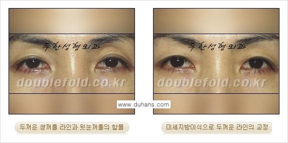 [두한성형외과 경쟁력 눈성형] - [미세지방이식으로 두꺼운 쌍꺼풀 라인의 교정 방법 안내] 관련 이미지 8