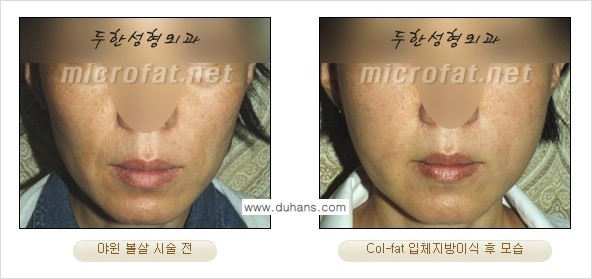 [두한성형외과 경쟁력 미세지방이식] - [Col-fat(콜펫) 지방이식의 특징과 차이점 안내] 관련 이미지 10