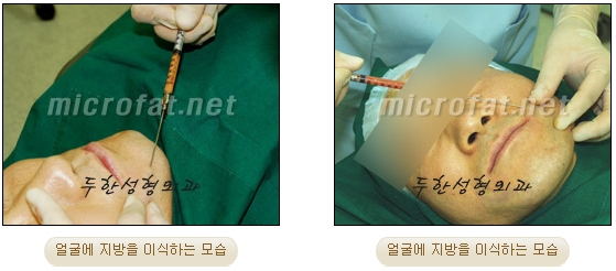 얼굴지방이식 두한성형외과 - 볼지방이식 관련 이미지 9