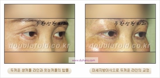 [두한성형외과 경쟁력 눈성형] - [쌍꺼풀 재수술에 대한 최선의 대안 제시] 관련 이미지 18