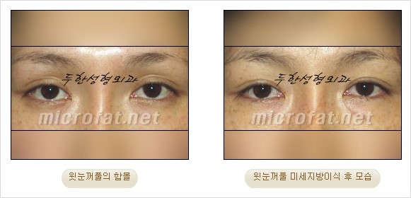 [두한성형외과 경쟁력 지방이식 리더] - [Col-fat(콜펫)지방이식, 3차원 입체지방이식, 2차원 평면지방이식] 관련 이미지 63