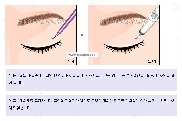 [두한성형외과 경쟁력 눈성형] - [윗눈꺼풀 지방제거 방법 안내] 관련 이미지 3