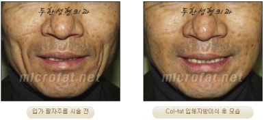 [두한성형외과 자가지방이식] - [3차원 미세지방이식] 관련 이미지 17