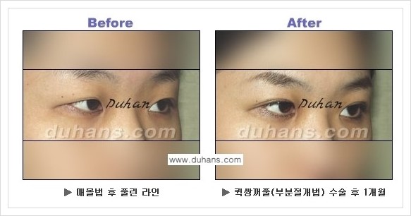 [두한성형외과 경쟁력 눈성형] - [퀵쌍꺼풀 수술 전후 정보 안내 ①] 관련 이미지 11