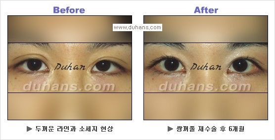[두한성형외과 경쟁력 눈성형] - [Dr. 컬럼  "어떤 쌍꺼풀이 아름다운 쌍꺼풀인가?!] 관련 이미지 9