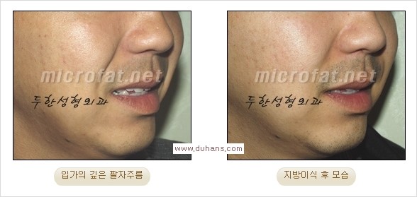 [두한성형외과 경쟁력 주름성형] - [입가와 팔자의 주름제거 지방이식 2.] 관련 이미지 3