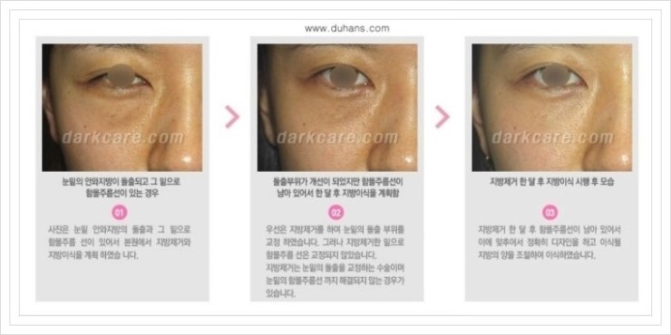[두한성형외과 경쟁력 눈밑성형] - [눈밑 지방재배치 문제점] 관련 이미지 4