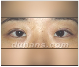 Candidates for Double Eyelid Revision Surgery: Unattractive Double Eyelids, Beautiful Double Eyelids image 18