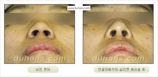 [두한성형외과 경쟁력 코성형 리더] - [자연스럽고 오똑한 콧망울! 코성형 방법]​ 관련 이미지 12