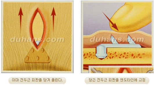 두한성형외과 안티에이징 리프팅 - 엔도타인 리프팅 관련 이미지 23