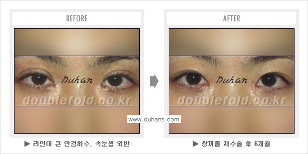 [두한성형외과 경쟁력 "극한 눈(쌍꺼풀) 재수술"] - ["극한 눈(쌍꺼풀) 재수술" 관련 질문과 답변 2.] 관련 이미지 3
