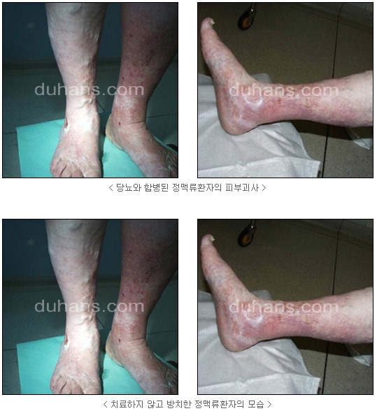 [두한성형외과 정맥류] - [정맥류의 원인과 문제점] 관련 이미지 1