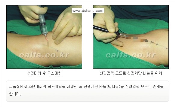 [두한성형외과 경쟁력 멀티종아리성형] - [종아리성형 방법별 전후 주의사항] 관련 이미지 7