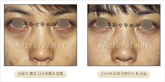 ​[두한성형외과 경쟁력 눈밑성형 리더] - [눈밑 다크써클의 증상, 원인, 종류, 치료방법 안내] 관련 이미지 43