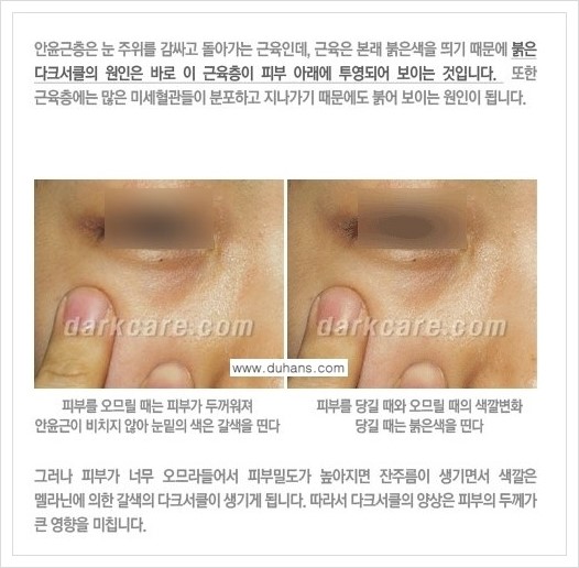 [두한성형외과 경쟁력 다크써클 교정] - [다크써클의 원인 안내] 관련 이미지 3