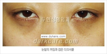 [두한성형외과 FOCUS 눈밑성형] - [다크써클의 치료방법 -  콜펫(Col-fat) 눈밑 미세지방이식 ③] 관련 이미지 3