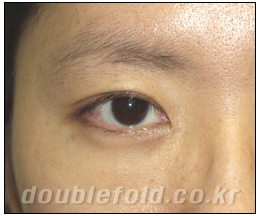 [Dohan Plastic Surgery Double Eyelid Surgery] - [Beautiful Double Eyelids] image 2