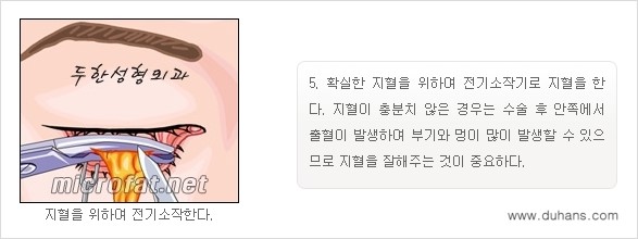 [두한성형외과 경쟁력 "지방제거"] - [눈 지방제거 1.] 관련 이미지 10