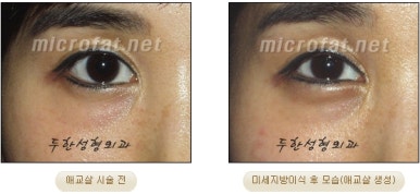 두한성형외과 눈밑성형 - 애교필러 후 눈밑재수술 관련 이미지 48