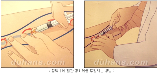 [두한성형외과 정맥류] - [하지정맥류, 정맥확장증, 혈관확장증] 관련 이미지 9