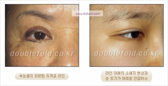 [두한성형외과 경쟁력 눈성형] - [두꺼운 아웃폴드 라인과 소세지 현상 완전절개법, 부분절개법 교정] 관련 이미지 2
