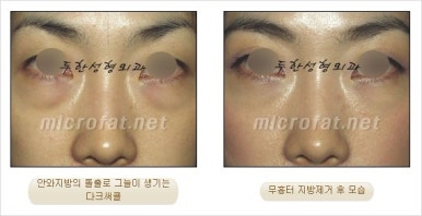두한성형외과 눈밑수술 - 다크서클 수술 전후 관리 안내 관련 이미지 45