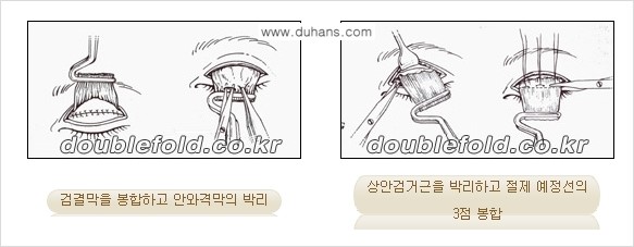 [두한성형외과 경쟁력 눈성형] - [안검하수 수술 방법] 관련 이미지 5