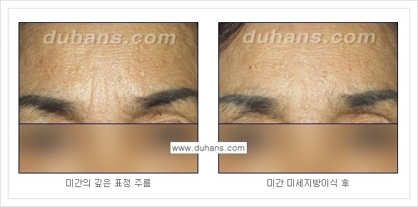​[두한성형외과 경쟁력 주름성형] - [주름교정을 위한 미세지방이식 안내 1.] 관련 이미지 15