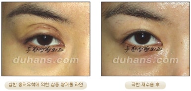[Special Double Eyelid Revision Surgery at Duhan Plastic Surgery] - [Restorative Surgery for Damaged Double Eyelid Eye Shape] image 7