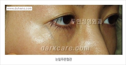 [두한성형외과 경쟁력 눈밑성형] - [눈밑 푸른 혈관 치료방법] 관련 이미지 1