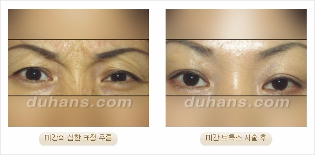 [두한성형외과 경쟁력 Quick 주름성형] - [주름교정을 위한 간편한 보톡스(보툴리눔톡신)] 관련 이미지 7