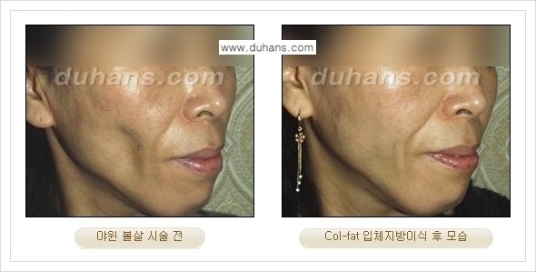 [두한성형외과 경쟁력 미세지방이식] - [지방이식 특허 Col-fat 미세지방이식 성공사례 안내] 관련 이미지 12