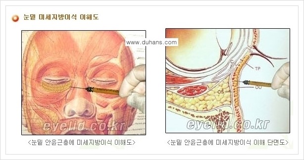 [두한성형외과 경쟁력 눈밑성형] - [다크써클 수술 안내 2.] 관련 이미지 1