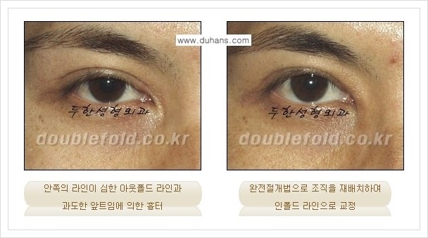 [두한성형외과 경쟁력 쌍꺼풀(눈) 재수술] - [심한 아웃폴드 라인을 인폴드 라인으로의 교정 안내] 관련 이미지 9