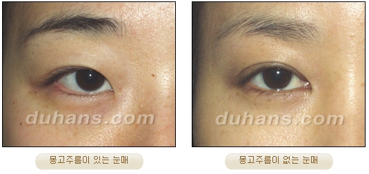 [DuHan Plastic Surgery Eye Surgery] - [Double Eyelid Surgery Guide] image 14
