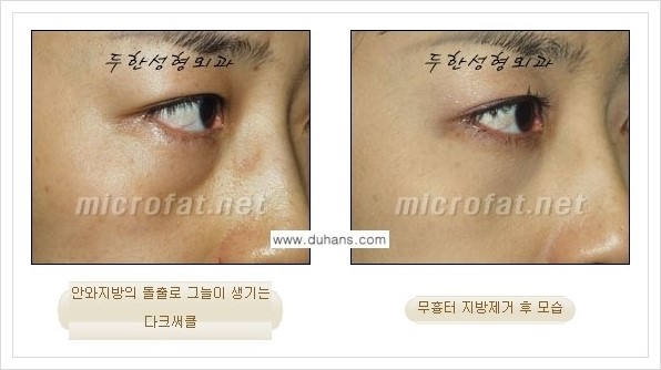 [두한성형외과 경쟁력 눈밑성형] - [눈밑지방제거, 눈위지방제거 안내 2.] 관련 이미지 18