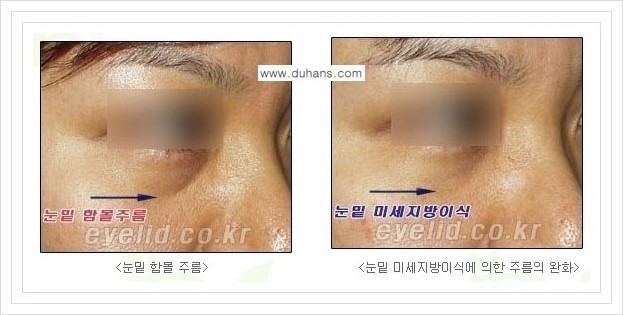 [두한성형외과 경쟁력 눈밑성형] - [눈밑 미세지방이식으로 다크써클 치료] 관련 이미지 6