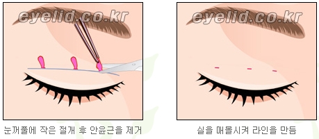 [두한성형외과 눈성형] - [쌍커풀수술] 관련 이미지 5