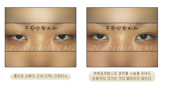 과교정 눈매 (소세지 쌍커풀 재수술, 눈매교정 재수술) 관련 이미지 6